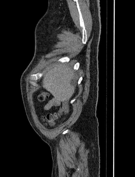 File:Abdominal aortic aneurysm rupture (Radiopaedia 54179-60362 Sagittal C+ arterial phase 1).jpg