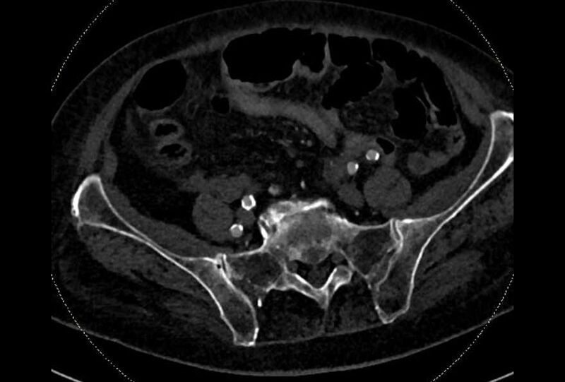 File:Abdominal aortic aneurysm with thrombus fissuration (Radiopaedia 73192-83919 Axial C+ arterial phase 162).jpg