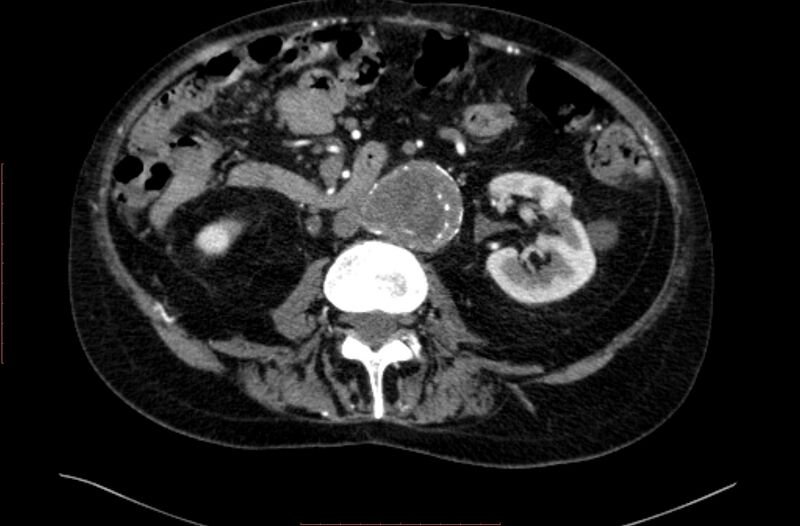 File:Abdominal aortic interposition tube graft and aneurysm thrombosis (Radiopaedia 71438-81857 Axial C+ arterial phase 79).jpg