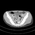 Abdominal multi-trauma - devascularised kidney and liver, spleen and pancreatic lacerations (Radiopaedia 34984-36486 Axial C+ portal venous phase 68).png