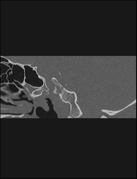 File:Aberrant right internal carotid artery (Radiopaedia 65191-74198 Sagittal non-contrast 88).jpg