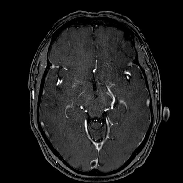 File:Accessory middle cerebral artery (Radiopaedia 73114-83828 Axial MRA 83).jpg