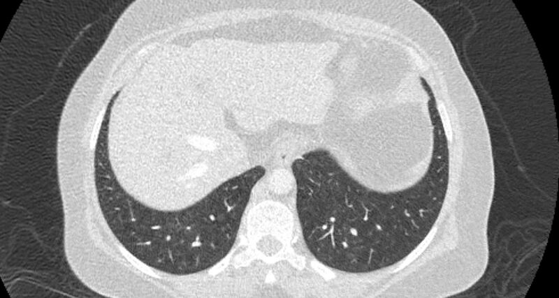 File:Accessory right inferior hepatic vein (Radiopaedia 65245-74259 Axial lung window 65).jpg