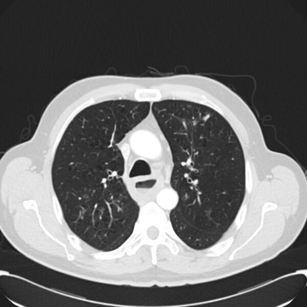 File:Achalasia (Radiopaedia 24937-25206 Axial lung window 11).jpg
