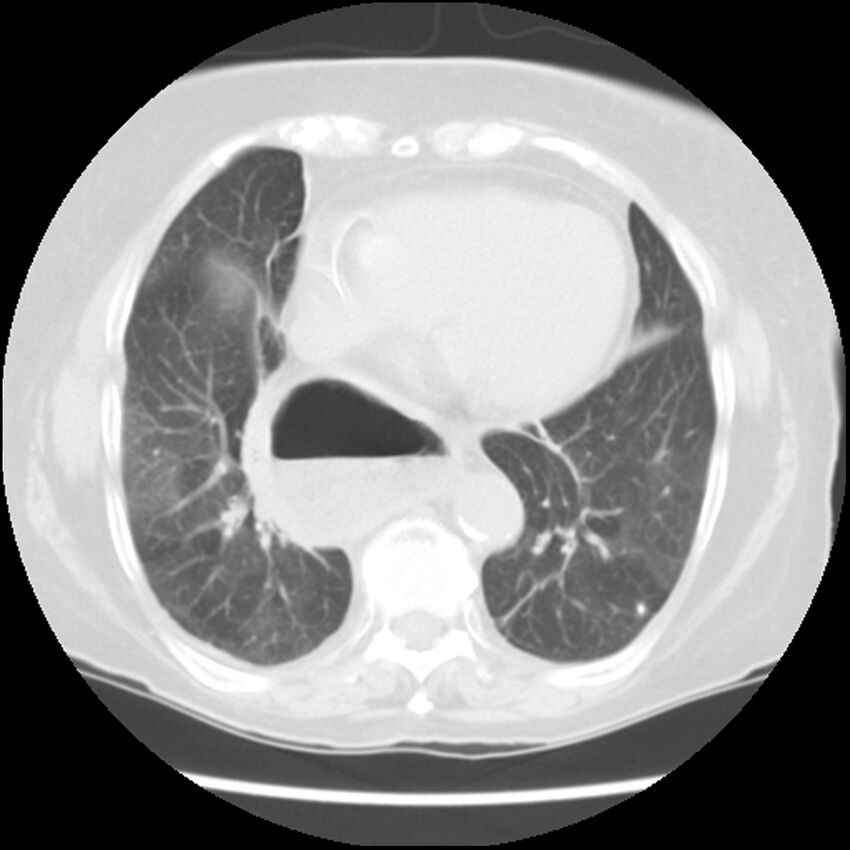 Achalasia (Radiopaedia 44094-47649 Axial lung window 41).jpg