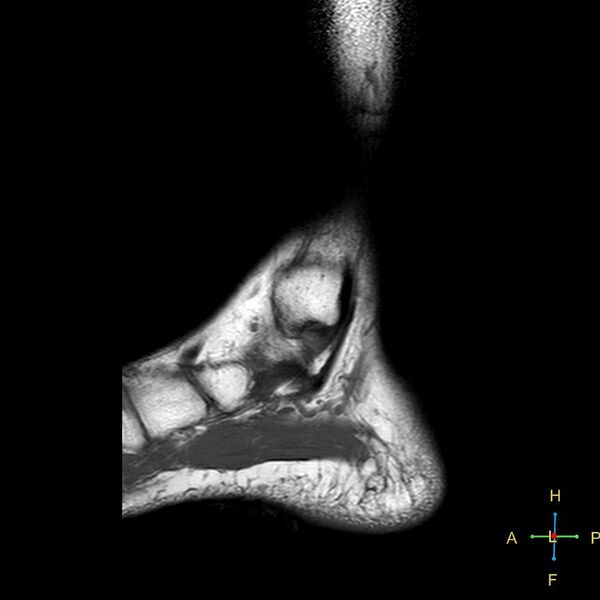 File:Achilles tendon complete tear (Radiopaedia 22834-22854 Sagittal T1 15).jpg