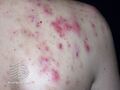 Acne affecting the back images (DermNet NZ acne-acne-back-172).jpg
