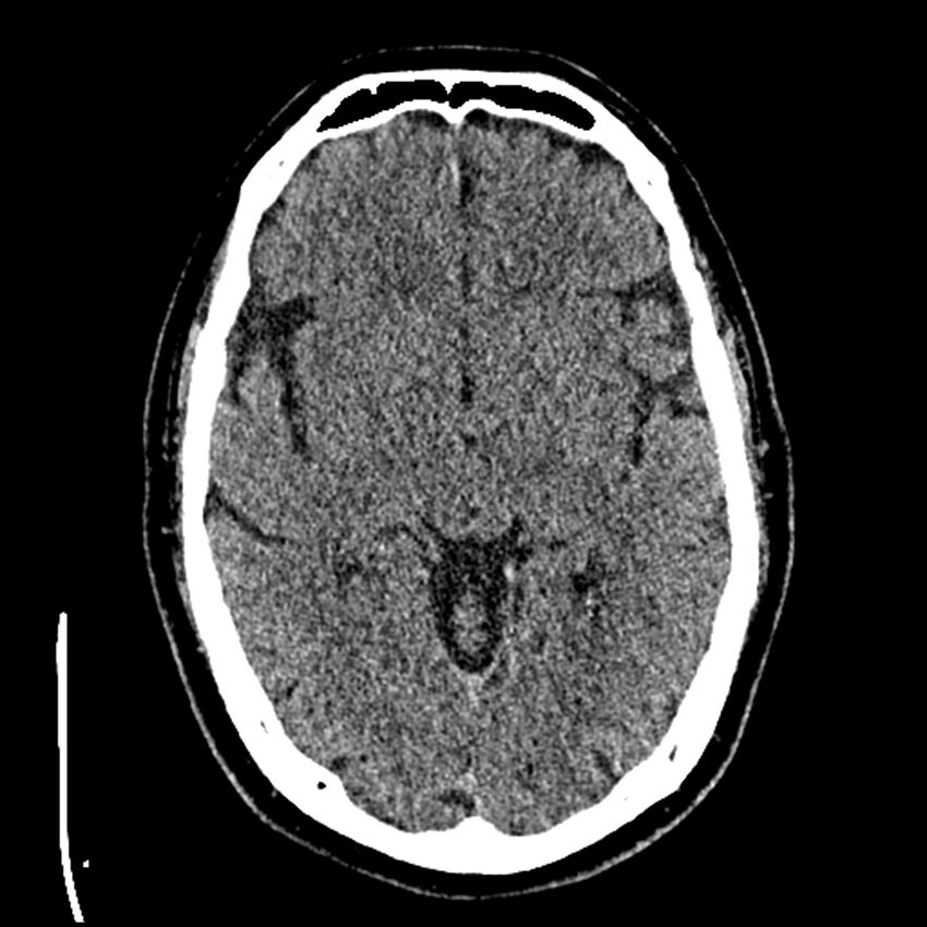 Acute A3 occlusion with ACA ischemic penumbra (CT perfusion) (Radiopaedia 72036-82525 Axial non-contrast thins 22).jpg