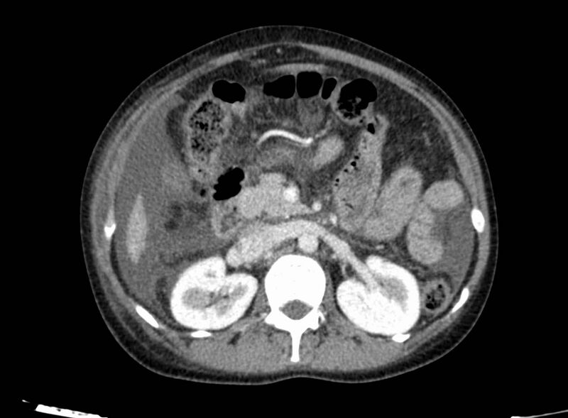 File:Acute Budd-Chiari syndrome (Radiopaedia 60858-68638 Axial C+ portal venous phase 121).jpg