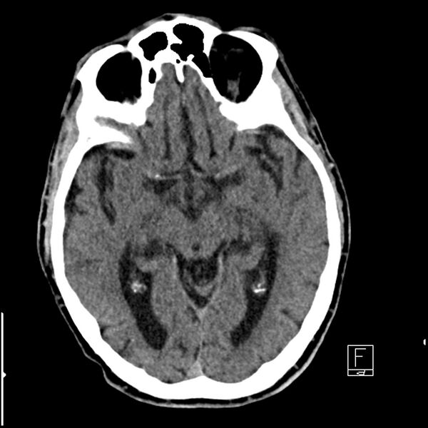 File:Acute ICA ischemic penumbra due to high-grade CCA stenosis (CT perfusion) (Radiopaedia 72038-82529 Axial non-contrast 20).jpg