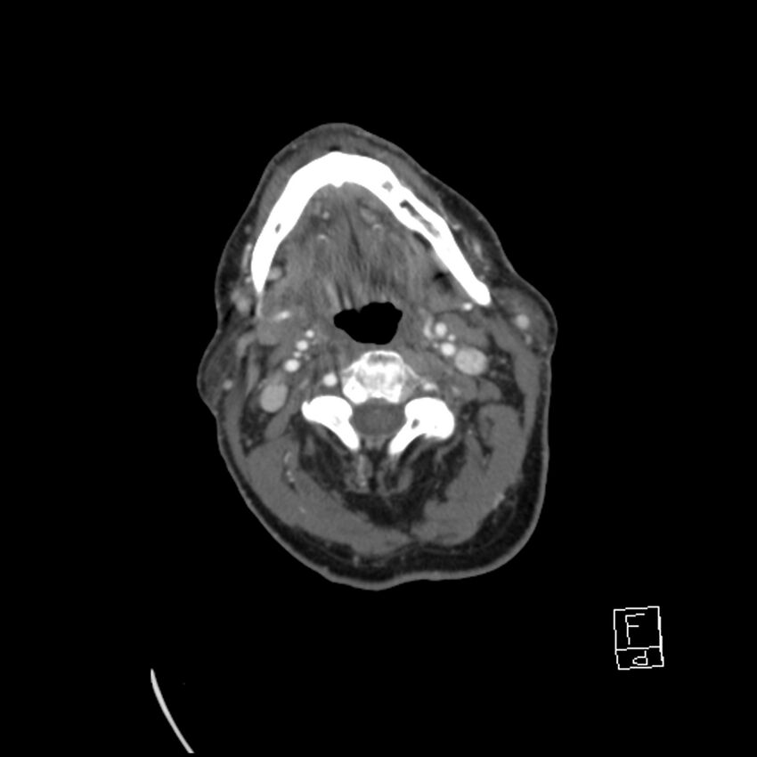 Acute ICA ischemic penumbra due to high-grade CCA stenosis (CT perfusion) (Radiopaedia 72038-82530 Axial C+ arterial phase 37).jpg