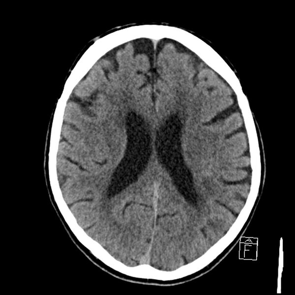 File:Acute P1 occlusion with PCA ischemia penumbra (CT perfusion) (Radiopaedia 72084-82586 Axial non-contrast 27).jpg