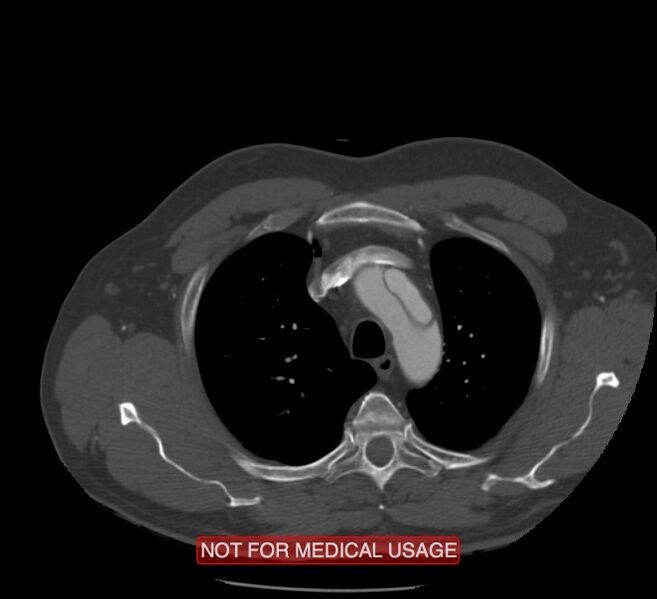 File:Acute aortic dissection - Stanford type A (Radiopaedia 40661-43285 Axial C+ arterial phase 3).jpg
