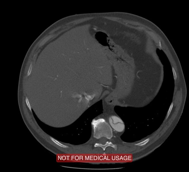 File:Acute aortic dissection - Stanford type A (Radiopaedia 40661-43285 Axial C+ arterial phase 68).jpg