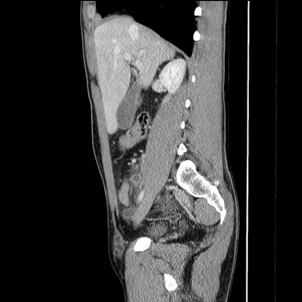 File:Acute appendicitis (Radiopaedia 27049-27227 Sagittal C+ portal venous phase 29).jpg