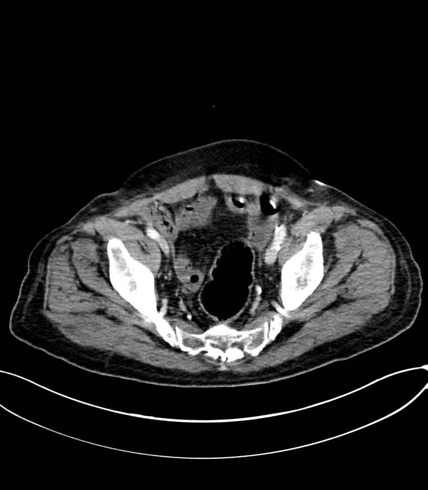 Acute arterial mesenteric ischemia (Radiopaedia 78238-90828 Axial C+ portal venous phase 122).jpg