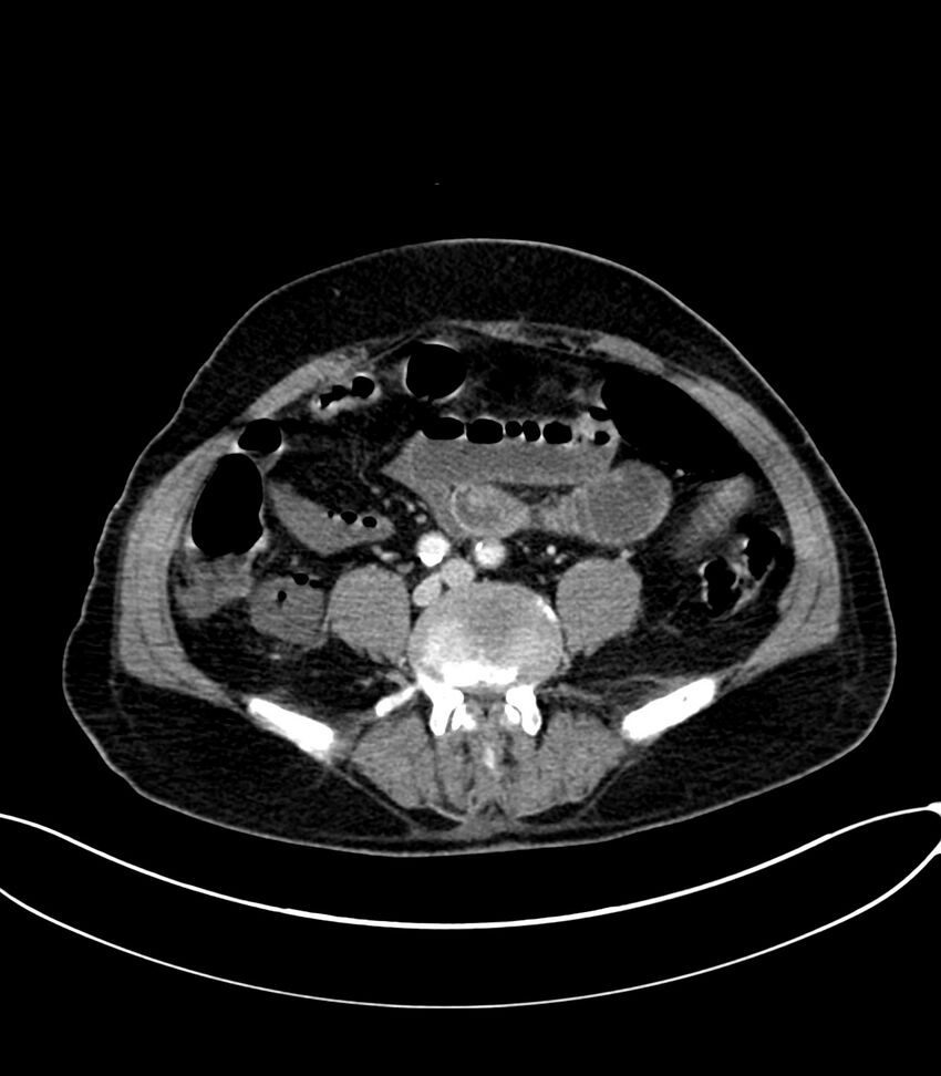 Acute arterial mesenteric ischemia (Radiopaedia 78238-90828 Axial C+ portal venous phase 91).jpg