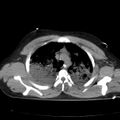 Acute aspiration pneumonitis (Radiopaedia 33605-34703 Axial non-contrast 32).jpg