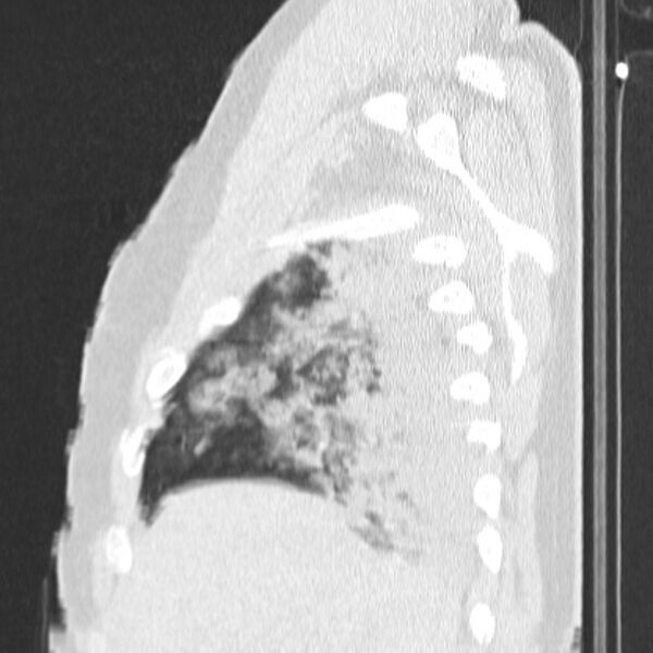 File:Acute aspiration pneumonitis (Radiopaedia 33605-34703 Sagittal lung window 18).jpg