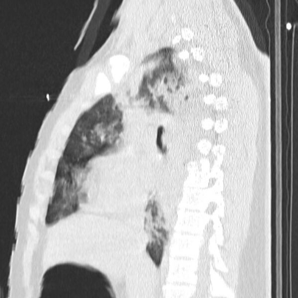 File:Acute aspiration pneumonitis (Radiopaedia 33605-34703 Sagittal lung window 41).jpg