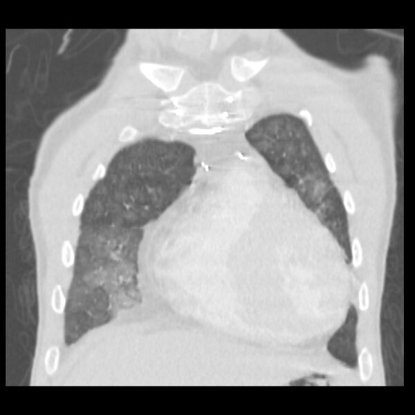 File:Acute diffuse alveolar hemorrhage (Radiopaedia 41323-44158 Coronal lung window 7).jpg