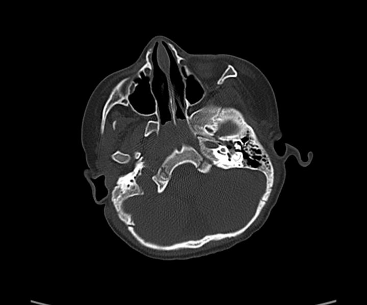 File:Acute hemorrhagic contusion (Radiopaedia 63660-72336 Axial bone window 14).jpg