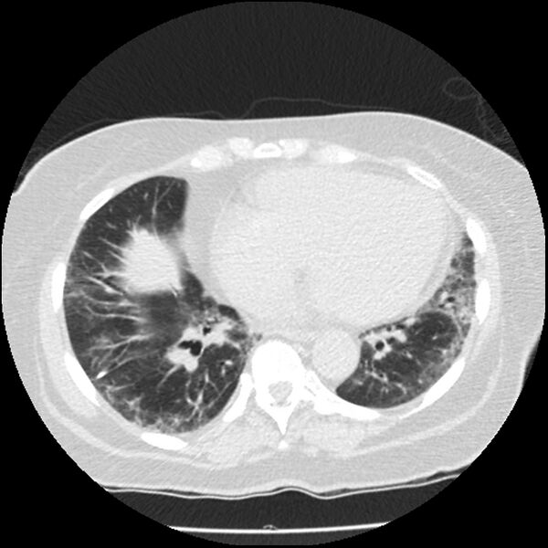 File:Acute interstitial pneumonitis (Radiopaedia 45404-49444 Axial lung window 70).jpg