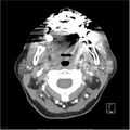 Acute left parotid sialadenitis (Radiopaedia 26160-26295 C+ arterial phase 19).jpg