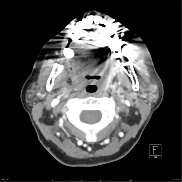 File:Acute left parotid sialadenitis (Radiopaedia 26160-26295 C+ arterial phase 19).jpg