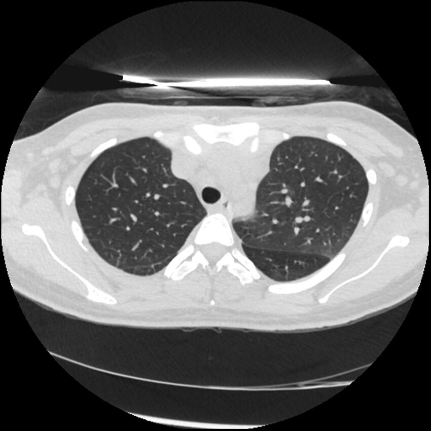 Acute lupus nephritis (Radiopaedia 45832-50107 Axial lung window 21).jpg