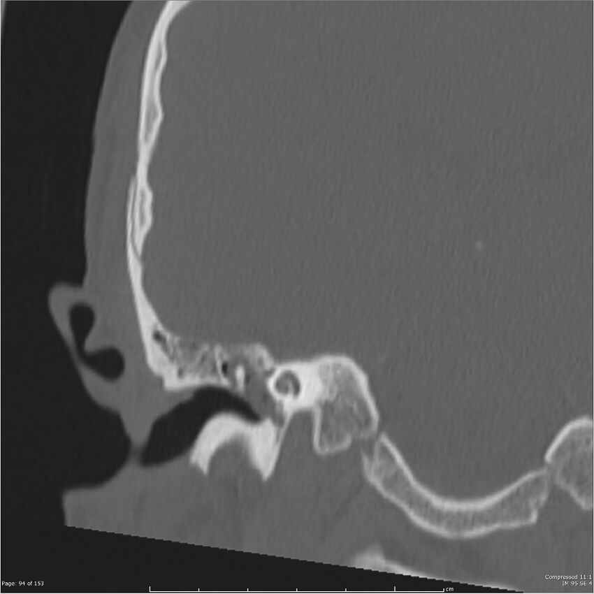 Acute otomastoiditis (Radiopaedia 28276-28512 Coronal PTB bone window reformat 25).jpg