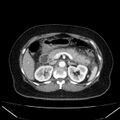 Acute pancreatitis - Balthazar C (Radiopaedia 26569-26714 Axial C+ arterial phase 31).jpg