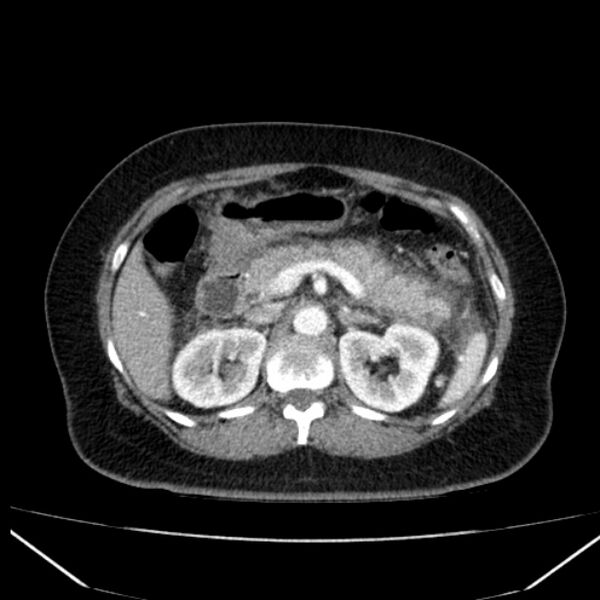 File:Acute pancreatitis - Balthazar C (Radiopaedia 26569-26714 Axial C+ arterial phase 31).jpg