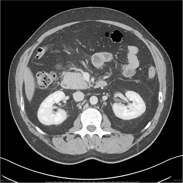 File:Acute pancreatitis - mild (Radiopaedia 27796-28033 C+ portal venous phase 18).jpg