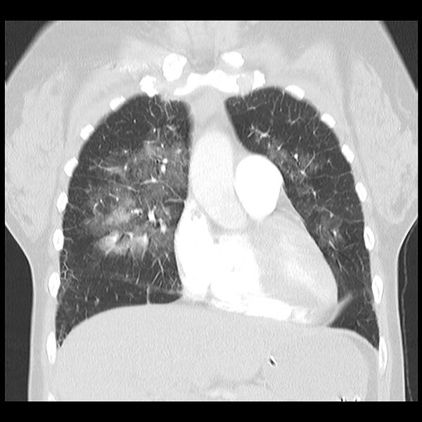 File:Acute pulmonary edema on CT (Radiopaedia 33582-34672 Coronal lung window 11).jpg