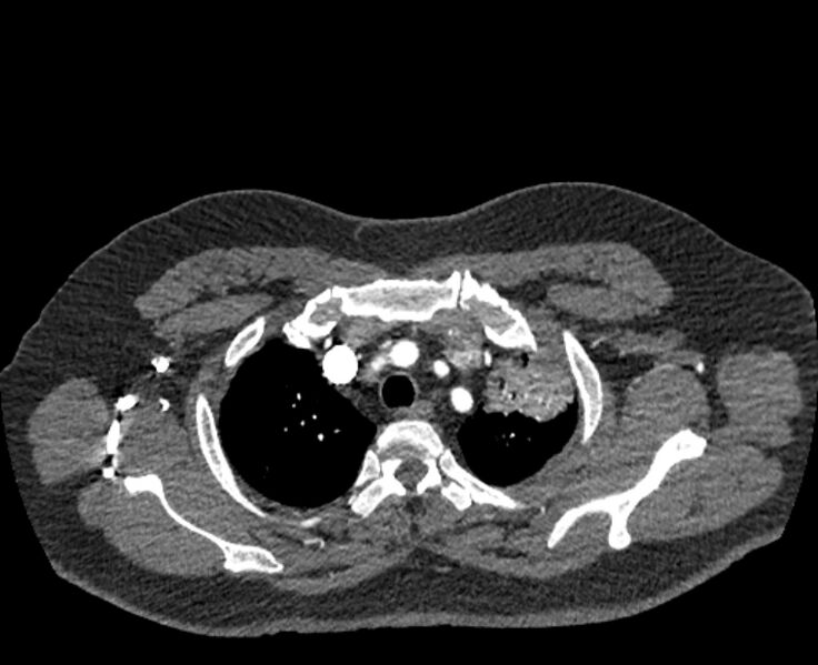 File:Acute pulmonary embolism with pulmonary infarcts (Radiopaedia 77688-89908 Axial C+ CTPA 7).jpg