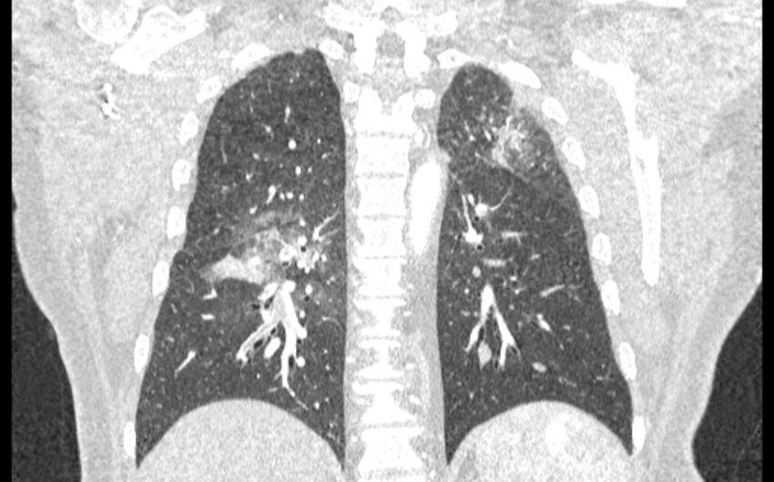 Acute pulmonary embolism with pulmonary infarcts (Radiopaedia 77688-89908 Coronal lung window 72).jpg