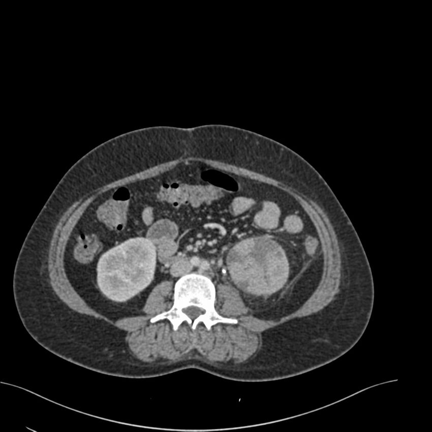 Acute pyelonephritis with renal vein thrombosis (Radiopaedia 58020-65053 Axial renal parenchymal phase 106).jpg
