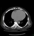 Acute renal failure post IV contrast injection- CT findings (Radiopaedia 47815-52559 Axial C+ portal venous phase 2).jpg