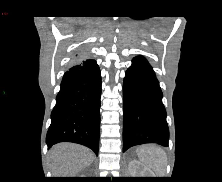 File:Acute right lung abscess (Radiopaedia 34806-36258 Coronal C+ arterial phase 8).jpg