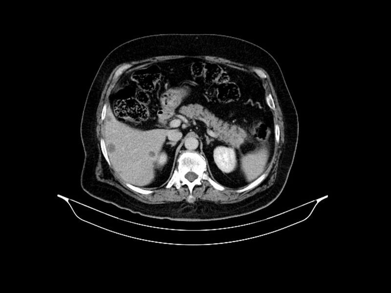 File:Adenocarcinoma of pancreas with hepatic metastasis (Radiopaedia 64332-73122 Axial C+ delayed 32).jpg