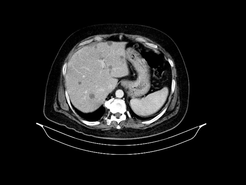File:Adenocarcinoma of pancreas with hepatic metastasis (Radiopaedia 64332-73122 Axial C+ portal venous phase 23).jpg