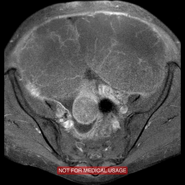 File:Adenocarcinoma of the cervix (Radiopaedia 28373-28615 Axial T1 C+ fat sat 18).jpg