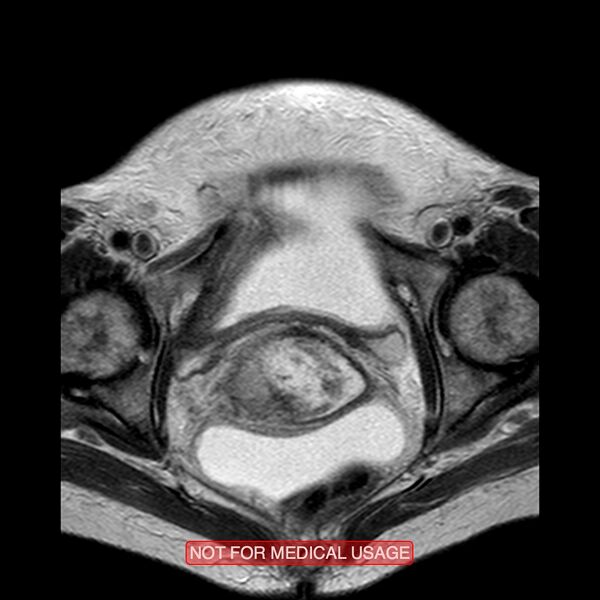 File:Adenocarcinoma of the cervix (Radiopaedia 28373-28615 Axial T2 6).jpg