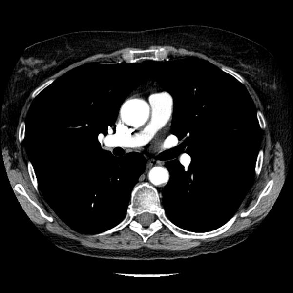 File:Adenocarcinoma of the lung (Radiopaedia 41015-43755 Axial C+ portal venous phase 56).jpg