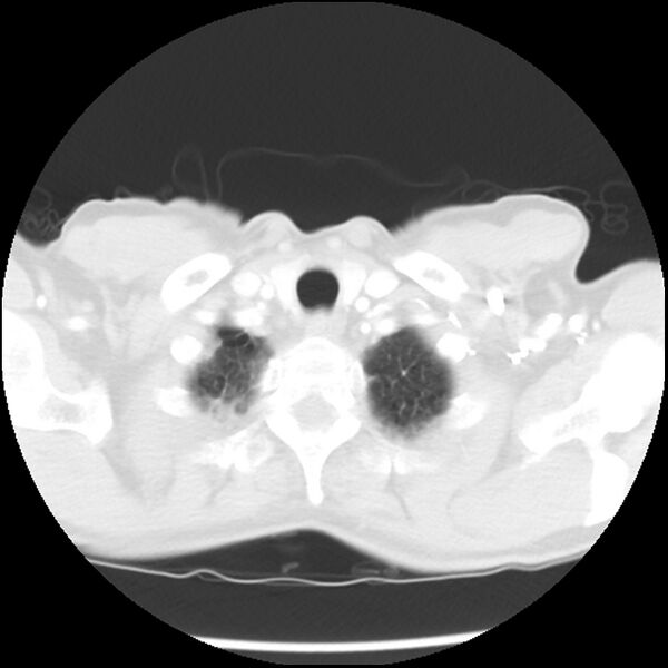 File:Adenocarcinoma of the lung - micropapillary predominant (Radiopaedia 42446-45563 Axial lung window 5).jpg