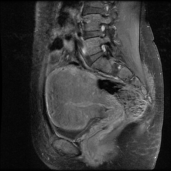 File:Adenomyosis on MRI (Radiopaedia 29328-29780 Sagittal T1 C+ fat sat 11).jpg