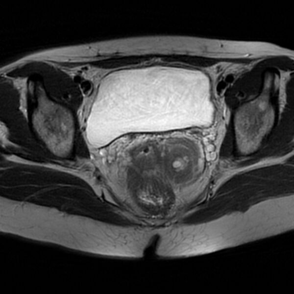 File:Adenomyosis within a septate uterus (Radiopaedia 69963-79981 Axial T2 22).jpg