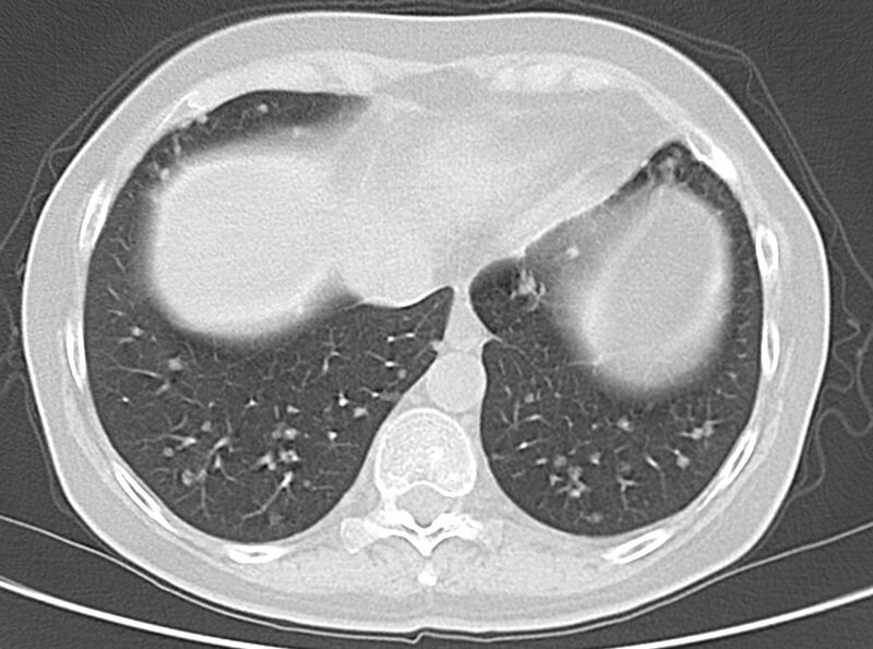 File:Adenosquamous lung carcinoma (Radiopaedia 22035-22030 lung window 48).jpg