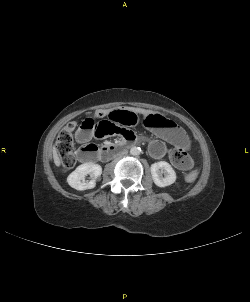 Adhesional small bowel obstruction (Radiopaedia 85402-101024 Axial C+ portal venous phase 133).jpg